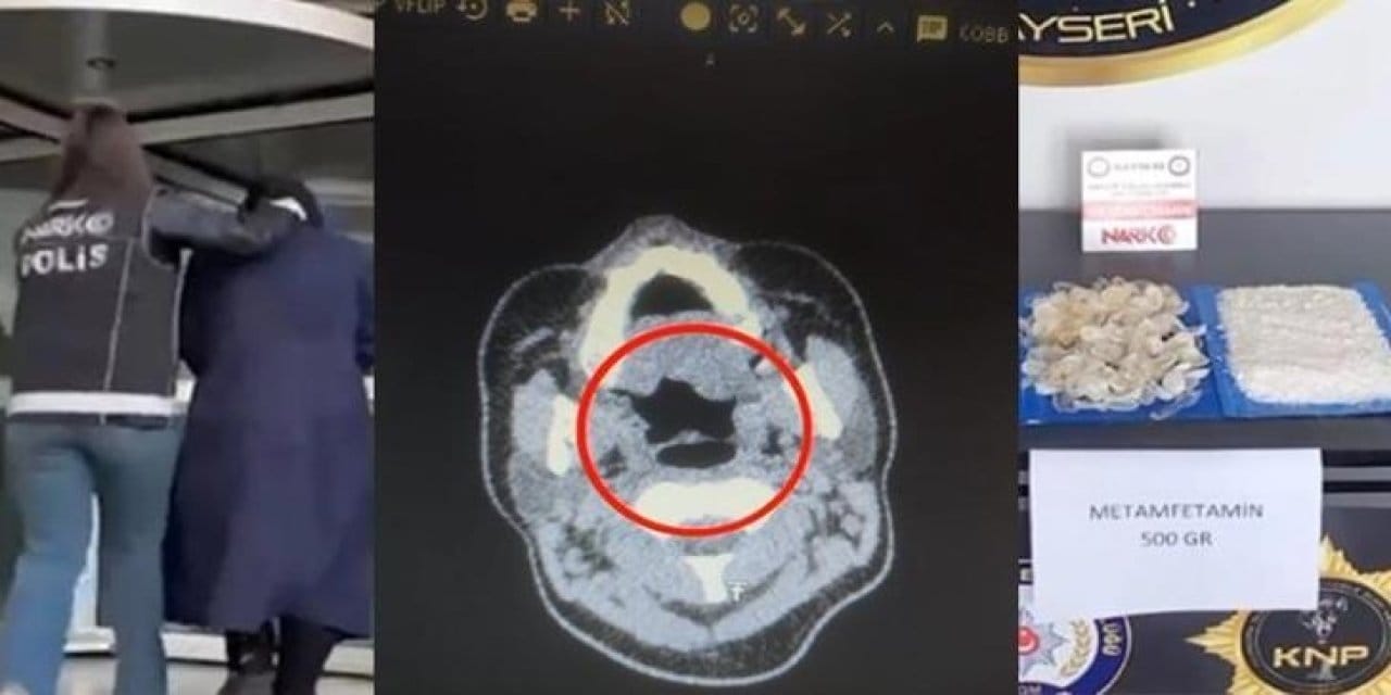 doktorlar bile inanamadi midesinden tam 500 gram metamfetamin cikti yLCpkKPY.jpg